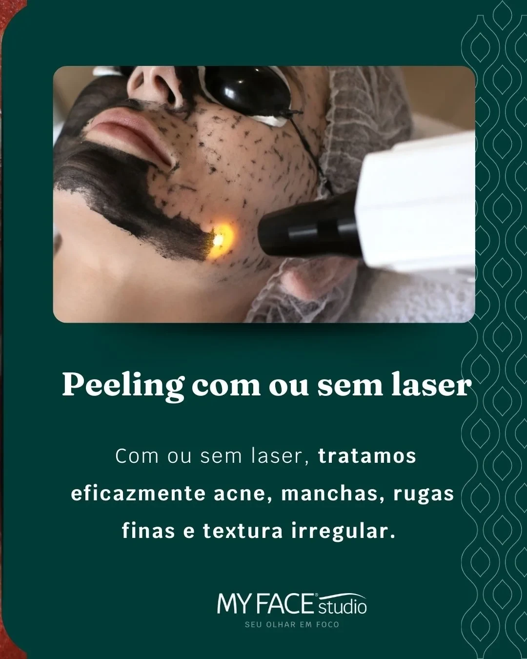 Peeling com laser no post original MyFace