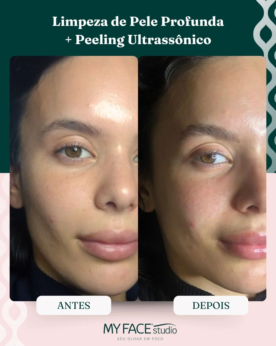 Limpeza de Pele Profunda + Peeling Ultrassônico: antes e depois identificados no post original MyFace