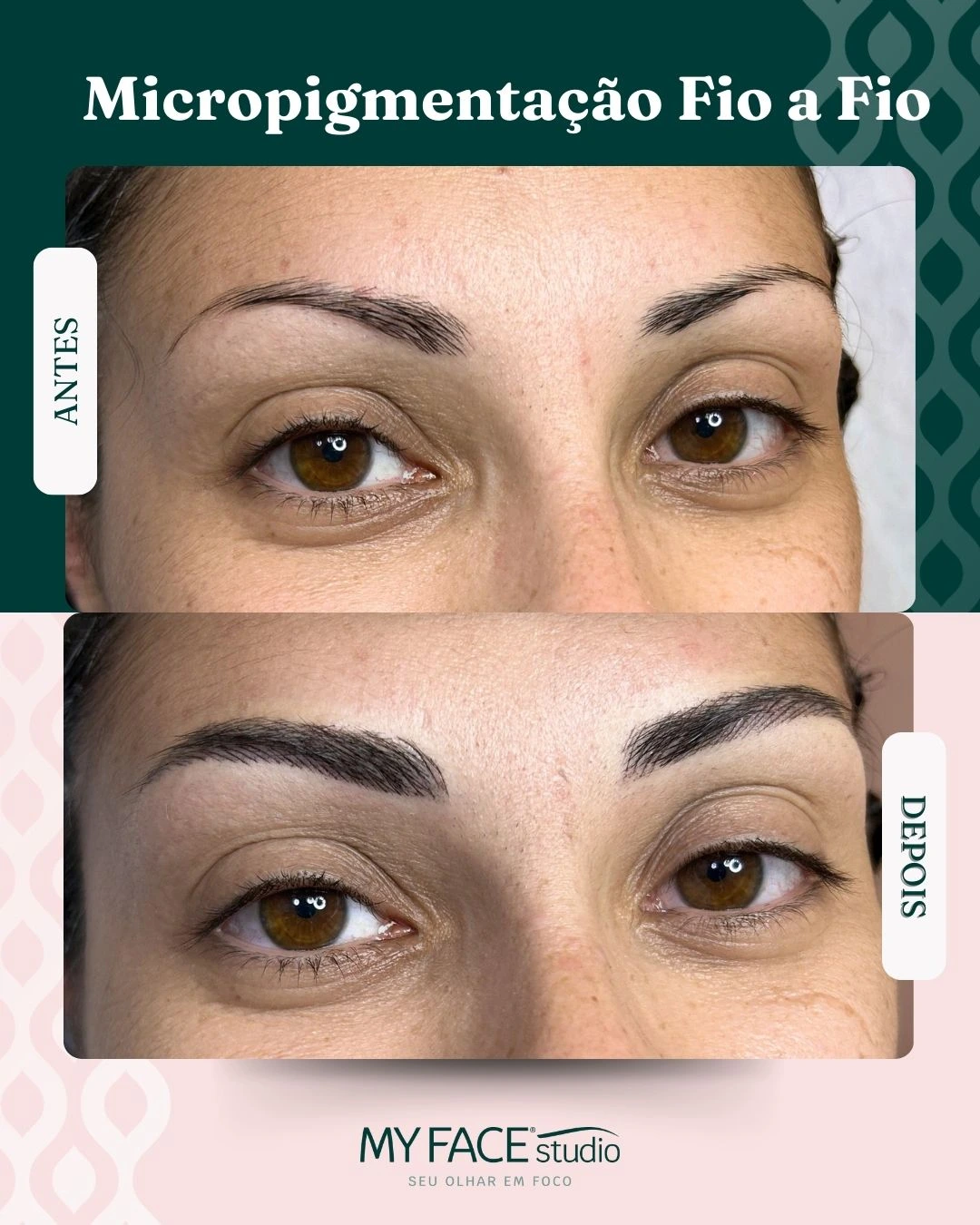 Micropigmentação Fio a Fio: antes e depois identificados no post original MyFace