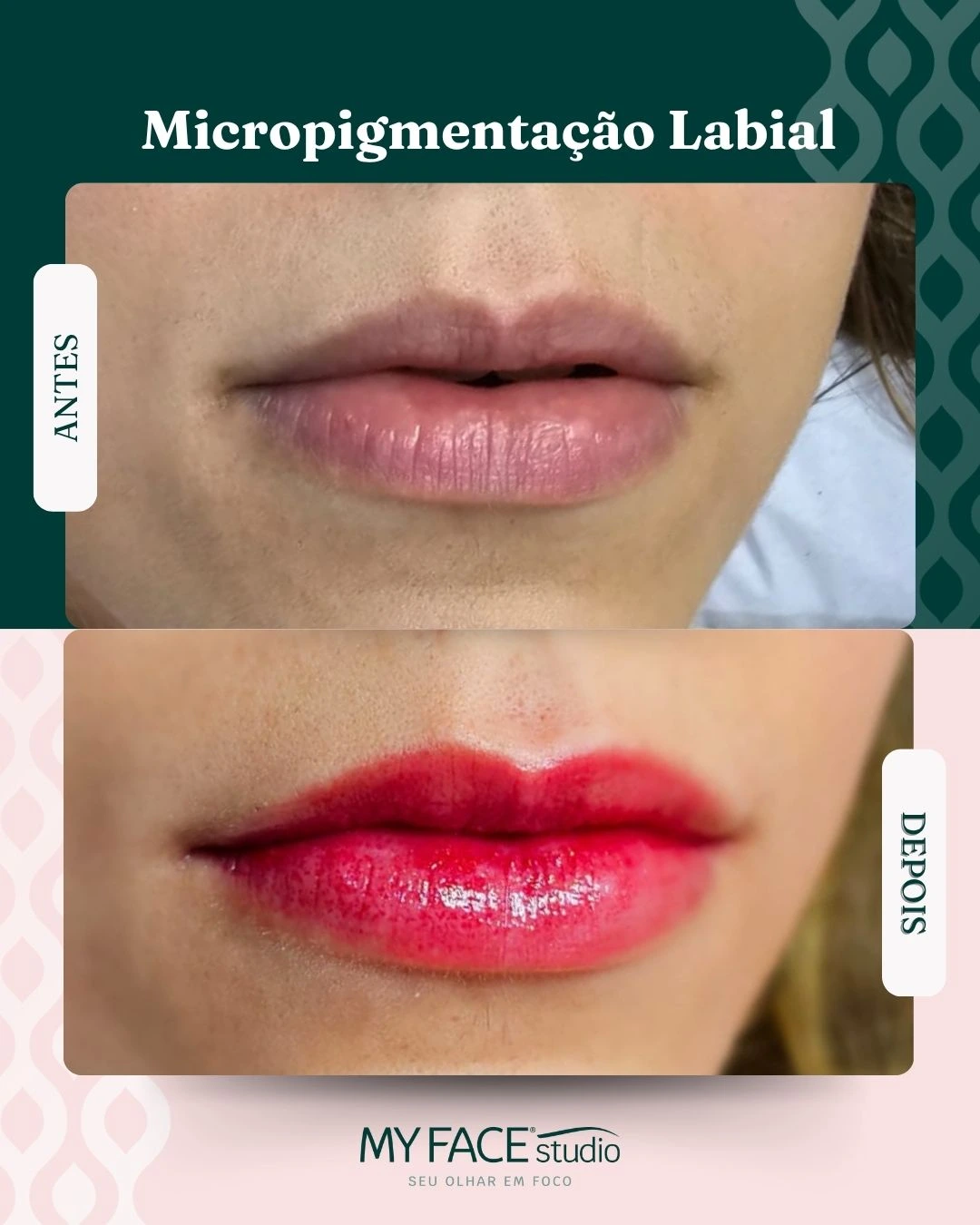 Micropigmentação Labial: antes e depois identificados no post original MyFace