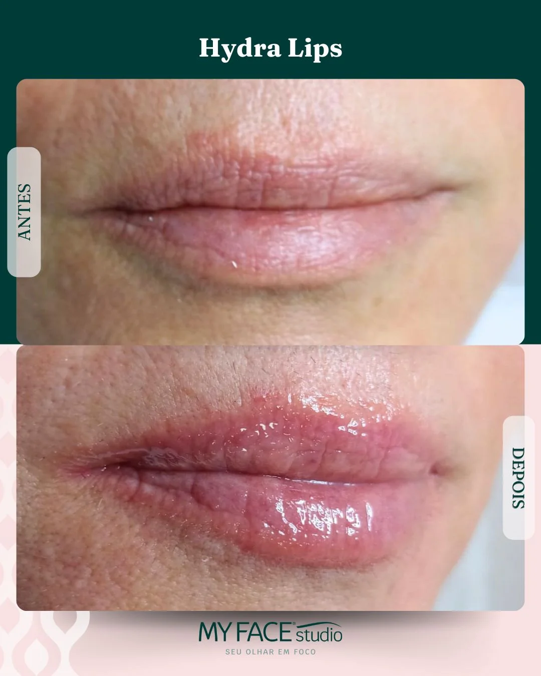 Hydra Lips: antes e depois identificados no post original MyFace